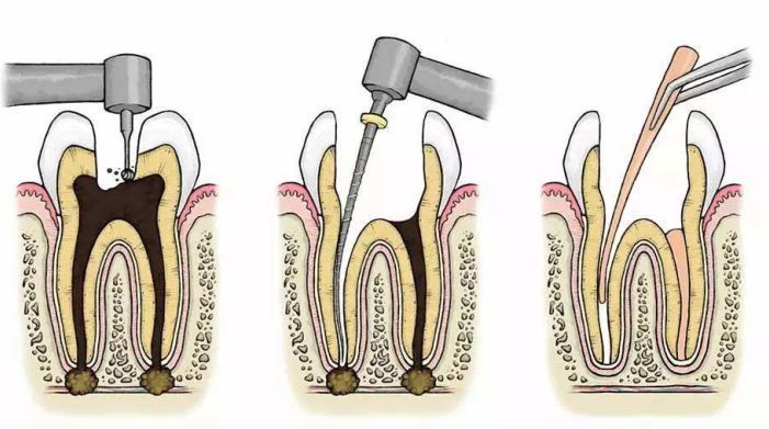 根管治疗的原理以及步骤